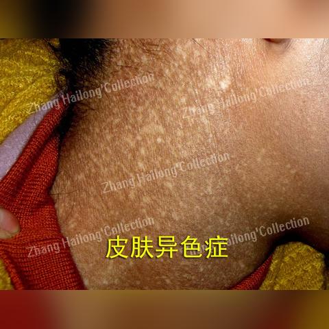 黑变病最新治疗方法解析