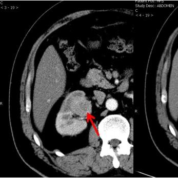 电子肾技术革新，引领肾脏健康新时代进展